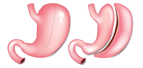 Ilustración de manga gástrica